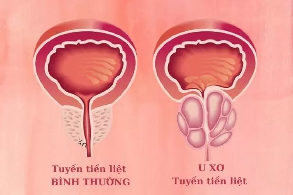 U tuyến tiền liệt có nhất thiết phải phẫu thuật hay không?